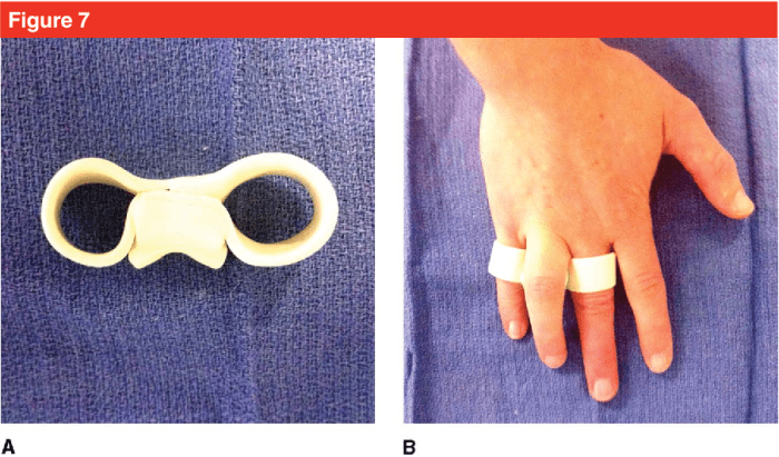 Yoke splint for middle finger